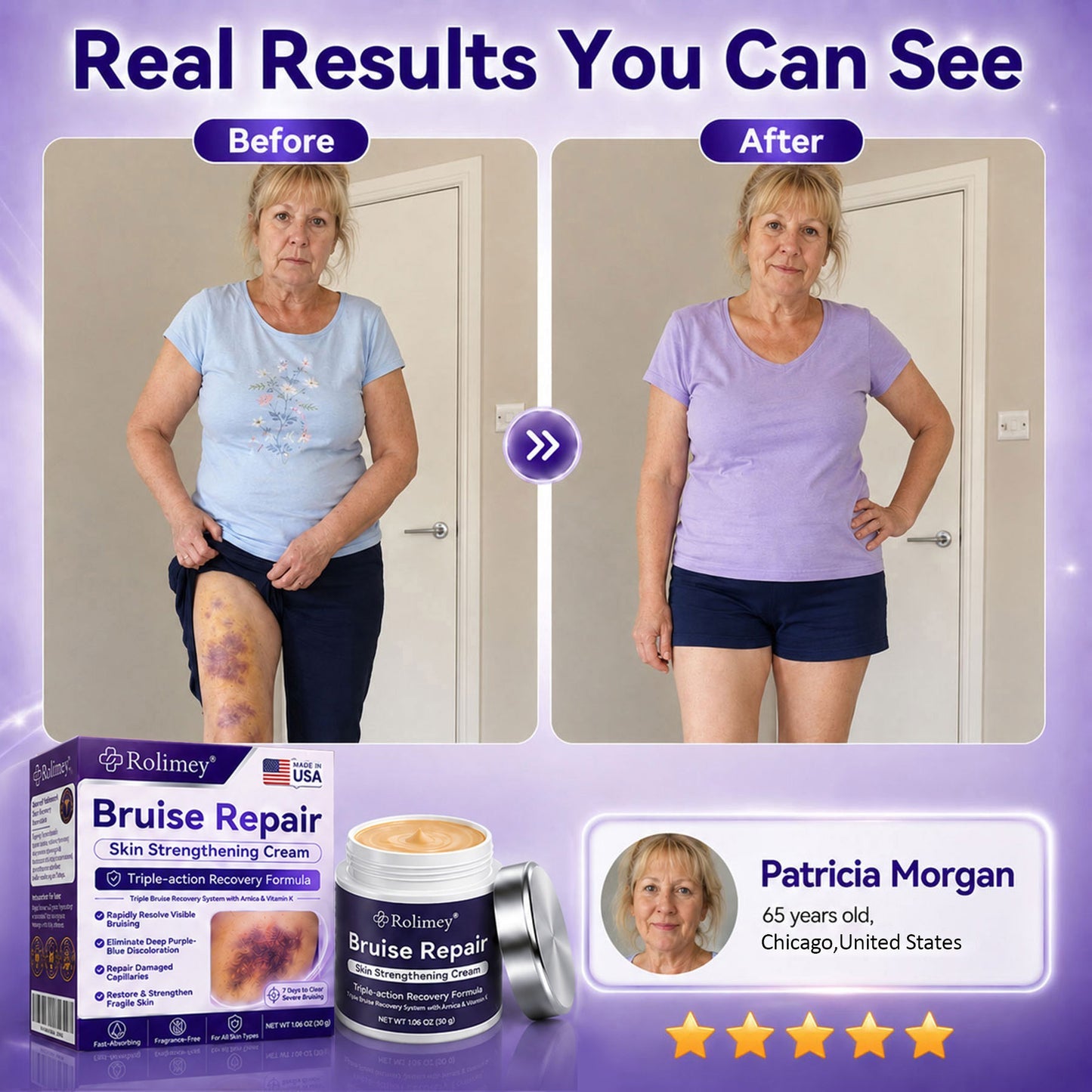 💫Over 100,000 units sold💕 - Rolimey® cream to repair bruises and strengthen the skin