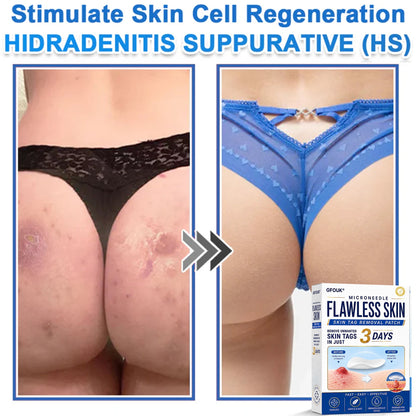 🆕GFOUK® 2026 Newly Upgraded 2-in-1 Microneedle Hydrocolloid Patches | Removes Raised Moles, Acne, Flat Warts, and Skin Tags | Improves Wrinkles, Scars, and Blemishes | Invisible Acne Patches for Face & Body