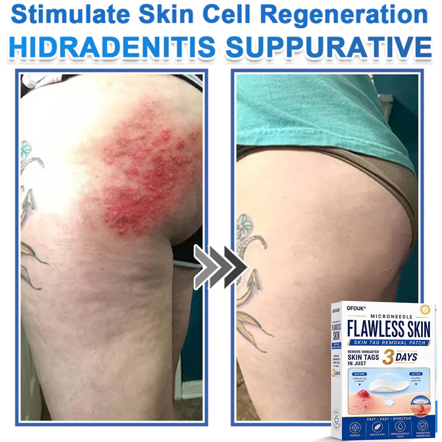 🆕GFOUK® 2026 Newly Upgraded 2-in-1 Microneedle Hydrocolloid Patches | Removes Raised Moles, Acne, Flat Warts, and Skin Tags | Improves Wrinkles, Scars, and Blemishes | Invisible Acne Patches for Face & Body
