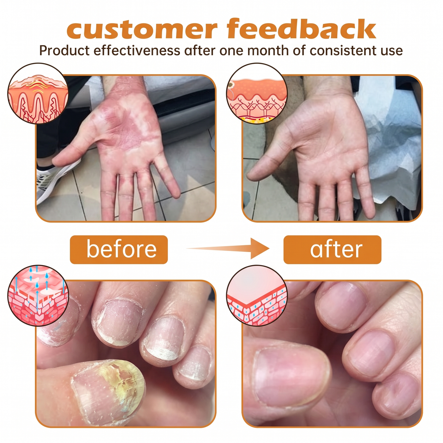 Rolimey® PsoriaHeal Bee Venom Psoriasis Treatment Spray(Suitable for all skin conditions)
