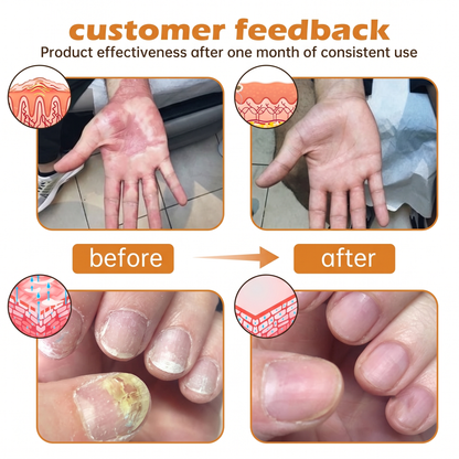 Rolimey® PsoriaHeal Bee Venom Psoriasis Treatment Spray(Suitable for all skin conditions)