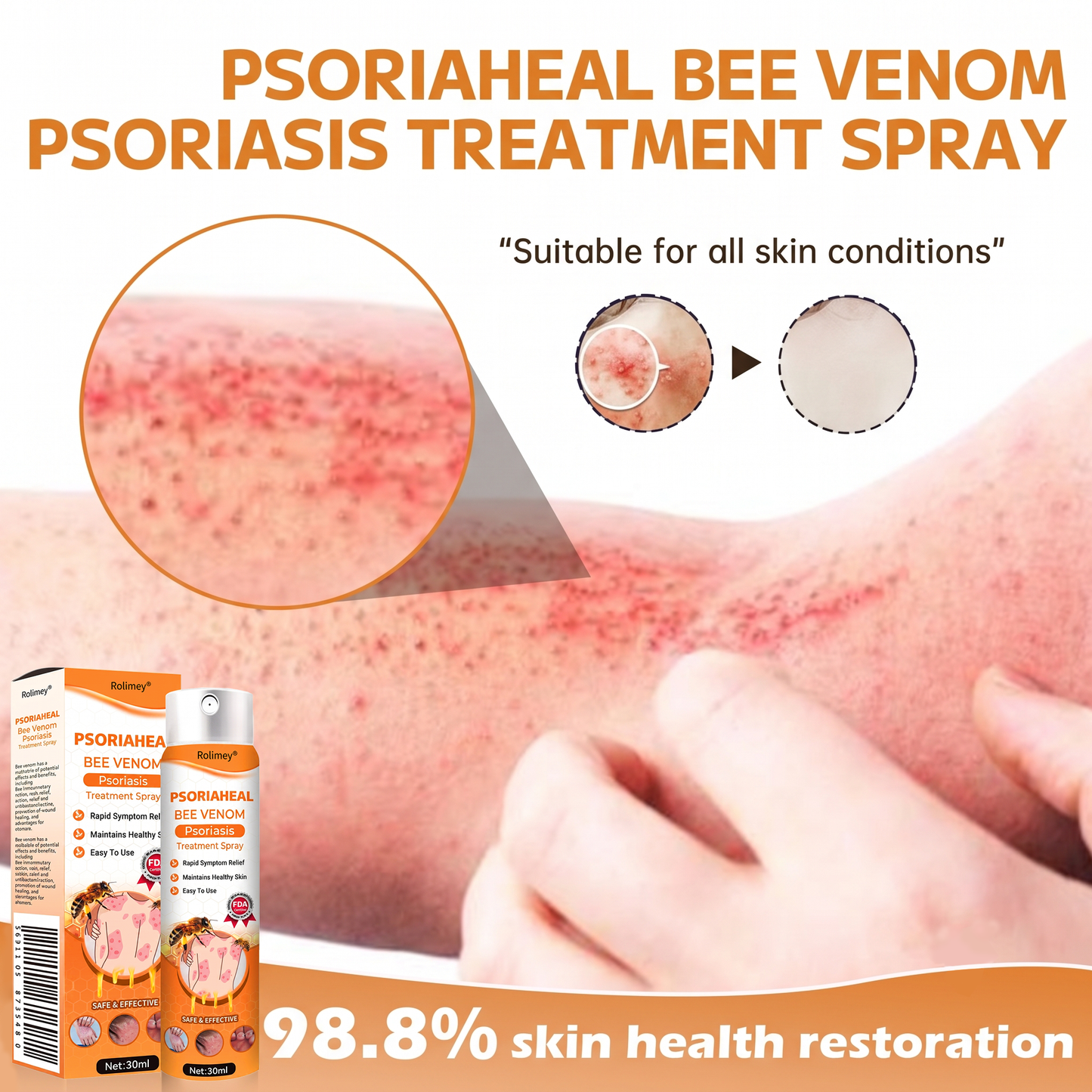 Rolimey® PsoriaHeal Bee Venom Psoriasis Treatment Spray(Suitable for all skin conditions)