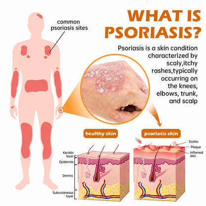 Rolimey® PsoriaHeal Bee Venom Psoriasis Treatment Spray(Suitable for all skin conditions)