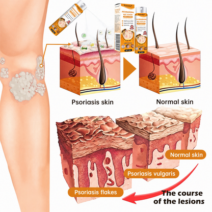 Rolimey® PsoriaHeal Bee Venom Psoriasis Treatment Spray(Suitable for all skin conditions)