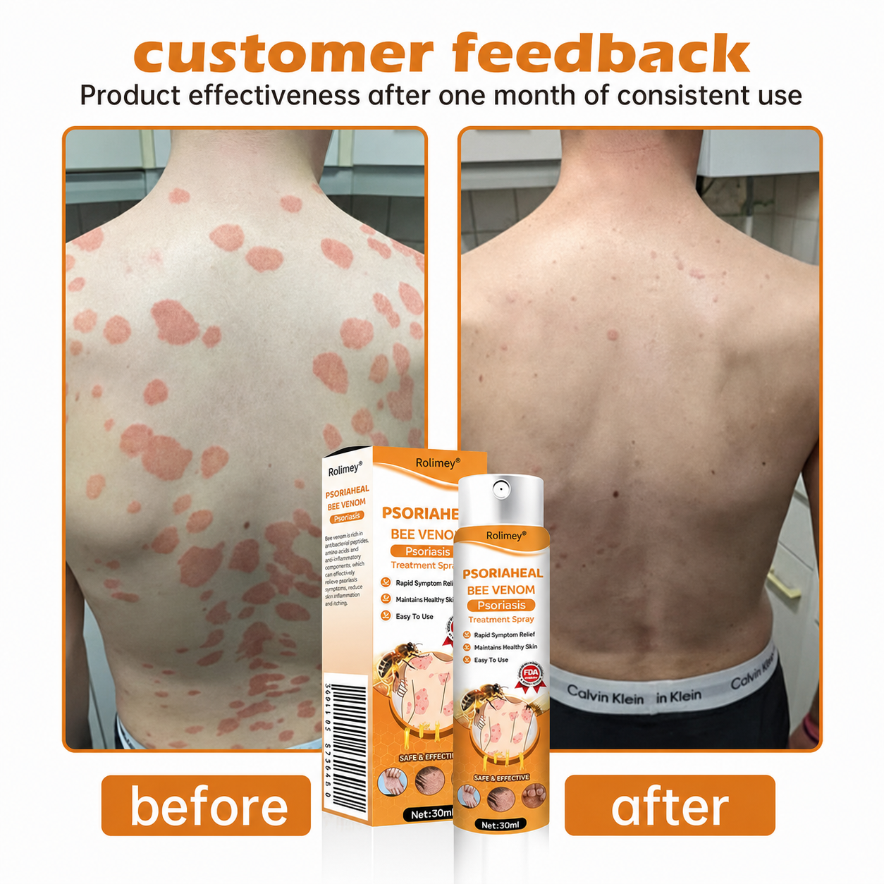 Rolimey® PsoriaHeal Bee Venom Psoriasis Treatment Spray(Suitable for all skin conditions)