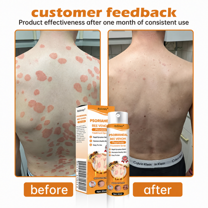 Rolimey® PsoriaHeal Bee Venom Psoriasis Treatment Spray(Suitable for all skin conditions)