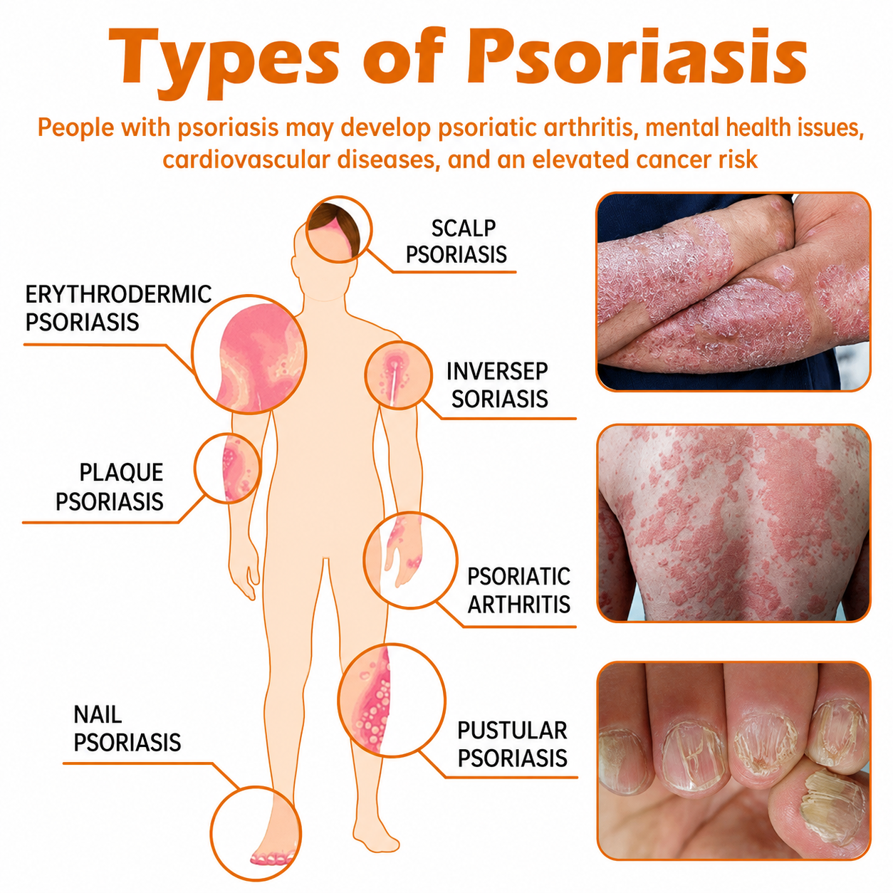 Rolimey® PsoriaHeal Bee Venom Psoriasis Treatment Spray(Suitable for all skin conditions)