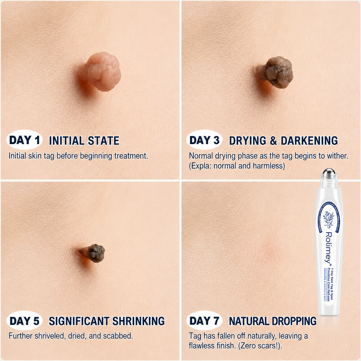 👨‍⚕️Official Brand Shop | 🔥Rolimey® 7-Day Roll-On for Skin Spots and Skin Tags – Pain-Free & Scar-Free