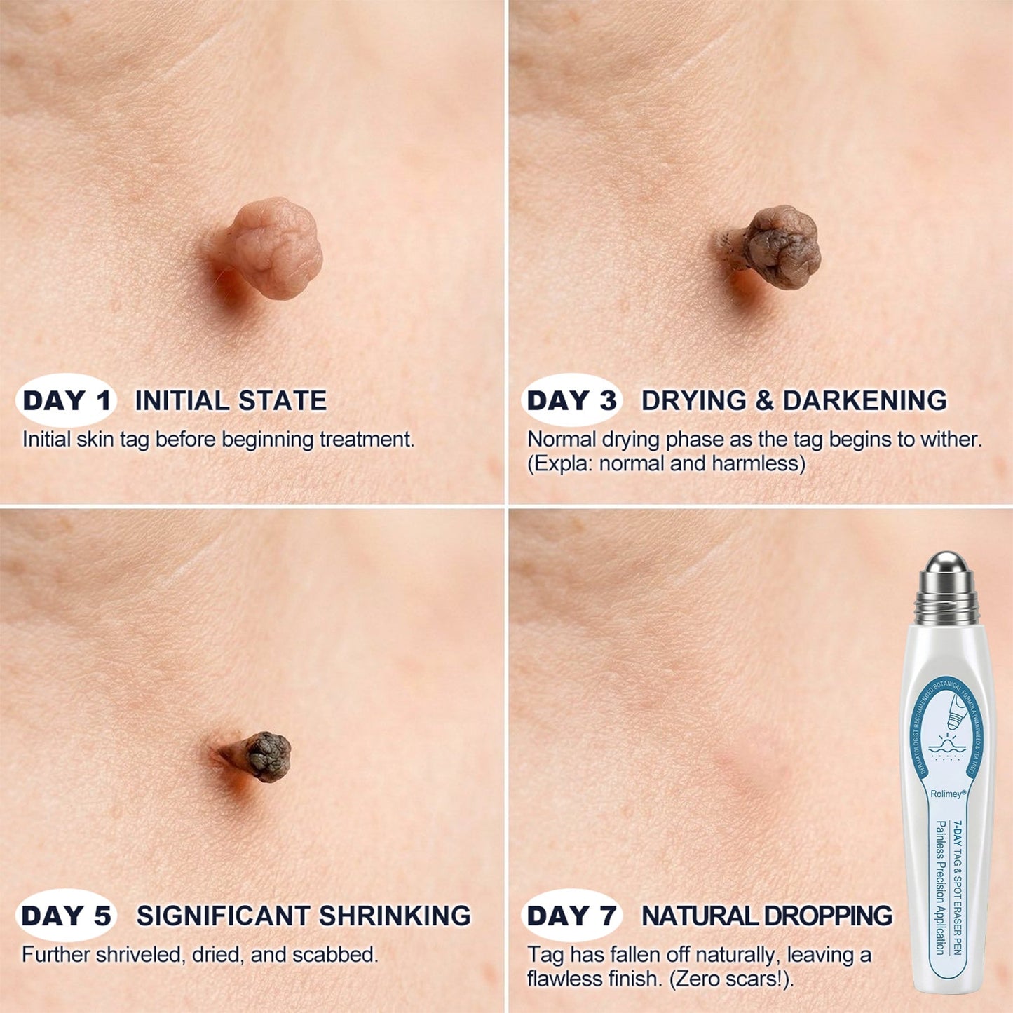 💕Official Brand Shop | Rolimey® 7-Day Roll-On for Skin Spots and Skin Tags – Pain-Free & Scar-Free