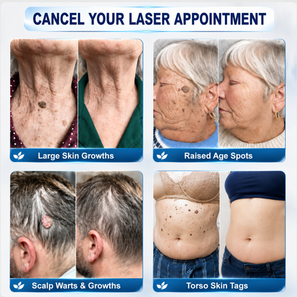👨‍⚕️Official Brand Shop | 🔥Rolimey® 7-Day Roll-On for Skin Spots and Skin Tags – Pain-Free & Scar-Free