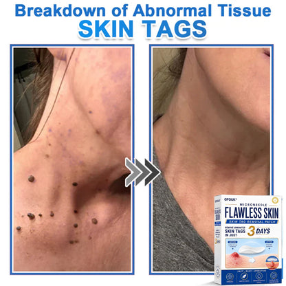 🆕GFOUK® 2026 Newly Upgraded 2-in-1 Microneedle Hydrocolloid Patches | Removes Raised Moles, Acne, Flat Warts, and Skin Tags | Improves Wrinkles, Scars, and Blemishes | Invisible Acne Patches for Face & Body