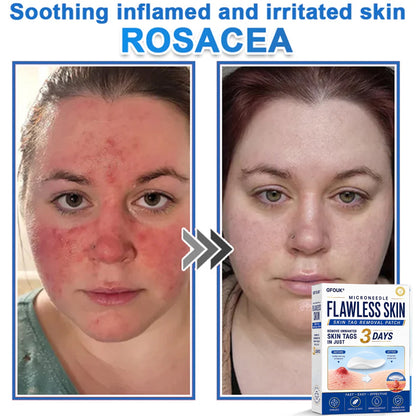 🆕GFOUK® 2026 Newly Upgraded 2-in-1 Microneedle Hydrocolloid Patches | Removes Raised Moles, Acne, Flat Warts, and Skin Tags | Improves Wrinkles, Scars, and Blemishes | Invisible Acne Patches for Face & Body