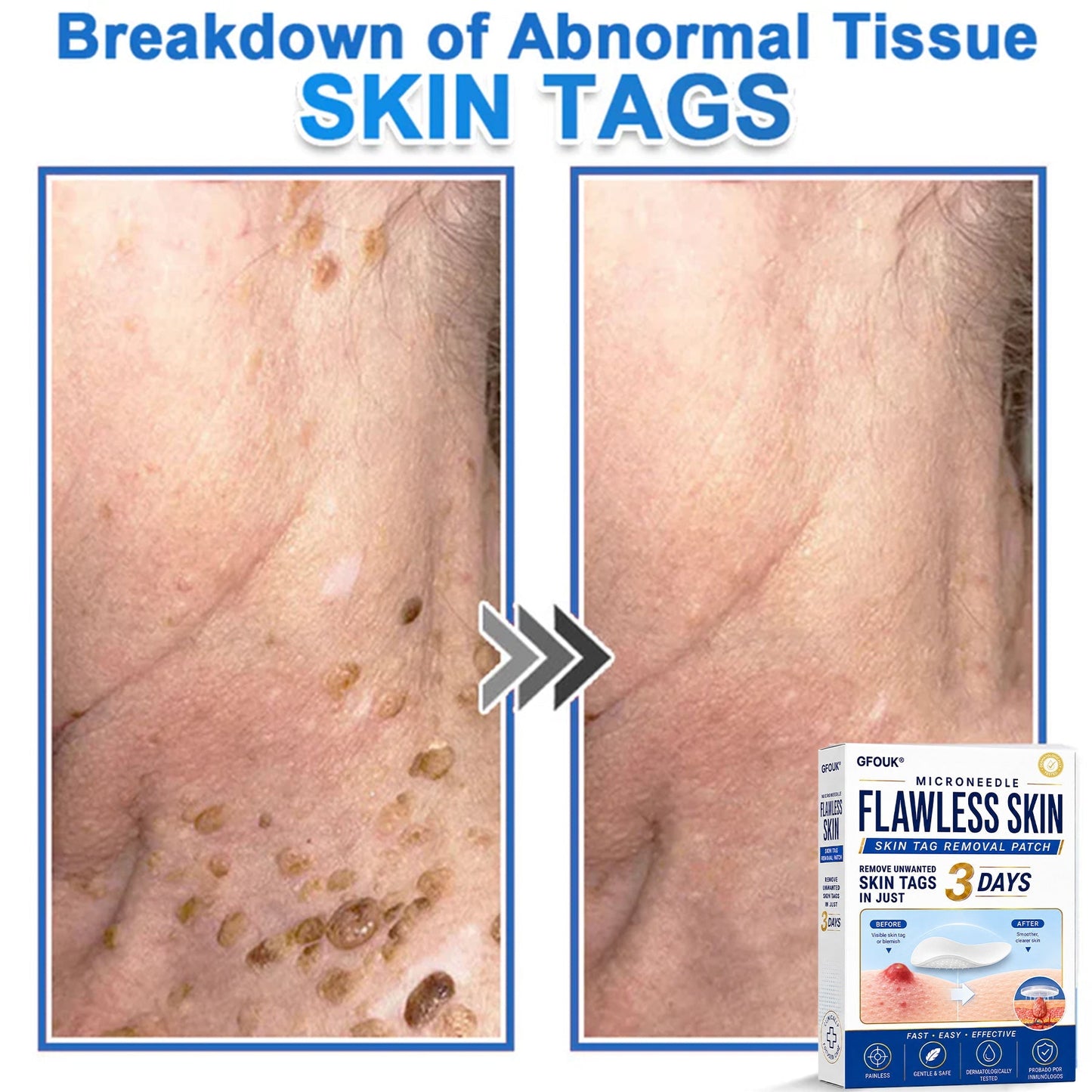 🆕GFOUK® 2026 Newly Upgraded 2-in-1 Microneedle Hydrocolloid Patches | Removes Raised Moles, Acne, Flat Warts, and Skin Tags | Improves Wrinkles, Scars, and Blemishes | Invisible Acne Patches for Face & Body