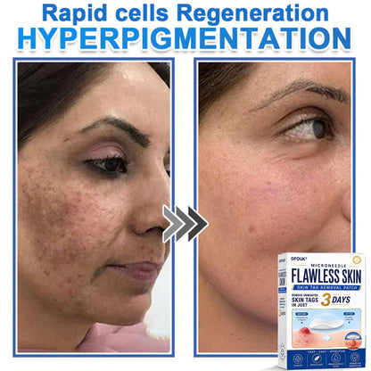 🆕GFOUK® 2026 Newly Upgraded 2-in-1 Microneedle Hydrocolloid Patches | Removes Raised Moles, Acne, Flat Warts, and Skin Tags | Improves Wrinkles, Scars, and Blemishes | Invisible Acne Patches for Face & Body