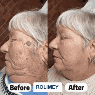 👨‍⚕️Official Brand Shop | 🔥Rolimey® 7-Day Roll-On for Skin Spots and Skin Tags – Pain-Free & Scar-Free